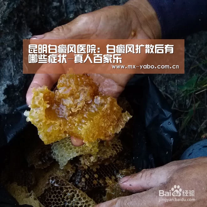 昆明白癜风医院:白癜风扩散后有哪些症状-真人百家乐(图3) 亚博体育官网